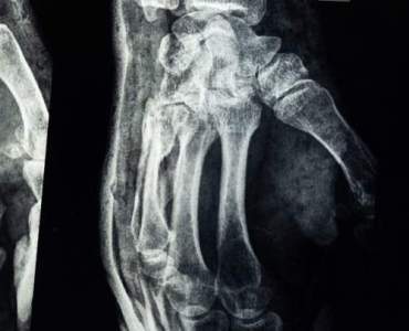 Zdravé kosti: tipy pro pevné kosti a zdravý životní styl