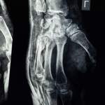 Zdravé kosti: tipy pro pevné kosti a zdravý životní styl